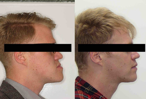 Jaw Surgery | Northenden House Orthodontics