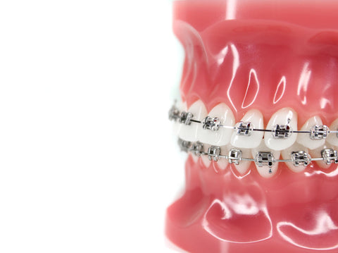 Metal Braces | Manchester Orthodontics