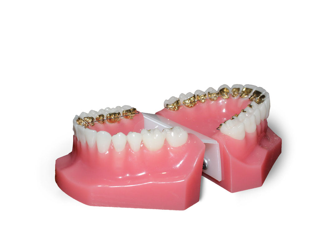 Lingual Braces, Hidden Braces