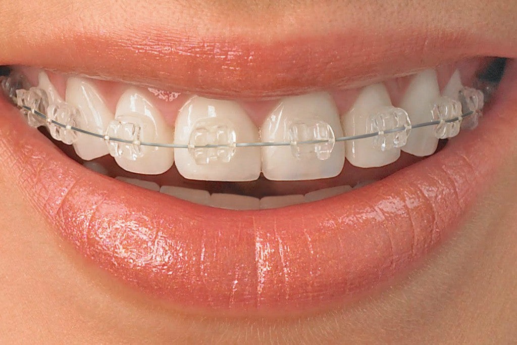 Ceramic Braces, Hidden Braces