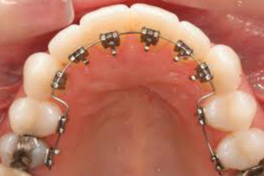 Lingual Braces | Hidden Braces | Manchester Orthodontics